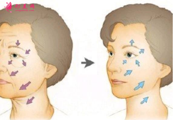 埋線面部提升