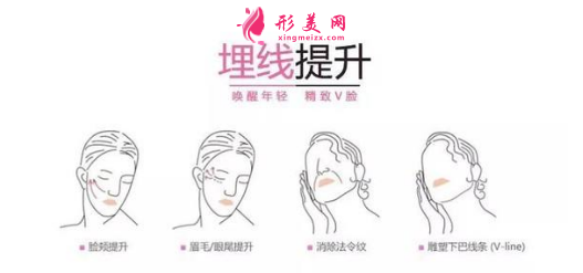 埋線面部提升