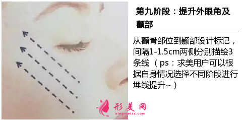北京面部提升術(shù)價(jià)格