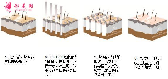 像素激光多少錢一次