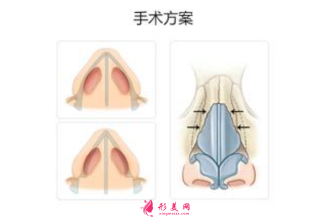 鼻骨縮小手術的難度