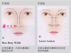 鼻骨縮小手術(shù)的難度大嗎？手術(shù)原理解析
