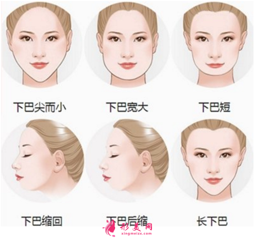 都說膨體容易感染，膨體墊下巴到底值不值得做？