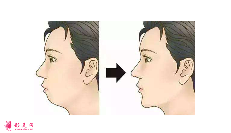 都說膨體容易感染，膨體墊下巴到底值不值得做？