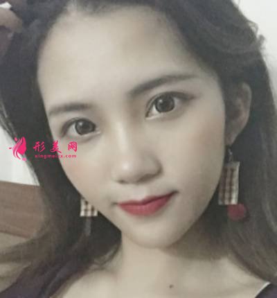 找李曾顯醫(yī)生注射肉毒素去木偶紋手術(shù)后38天