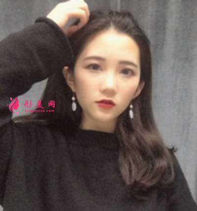 找李曾顯醫(yī)生注射肉毒素去木偶紋手術(shù)后45天