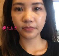 李曾顯醫(yī)生注射肉毒素去木偶紋真實(shí)體驗(yàn)及效果圖