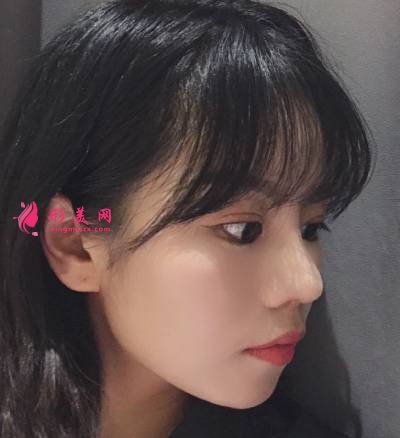 在重慶好美找畢勝做鼻綜合整形手術(shù)后25天