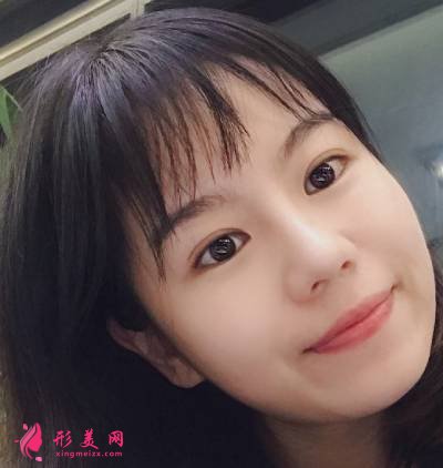 在重慶好美找畢勝做鼻綜合整形手術(shù)后80天