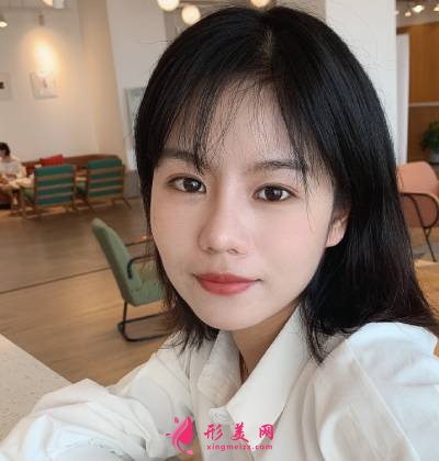 在重慶好美找畢勝做鼻綜合整形手術(shù)后40天