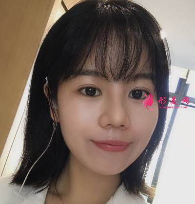 在重慶好美找畢勝做鼻綜合整形手術(shù)后10天