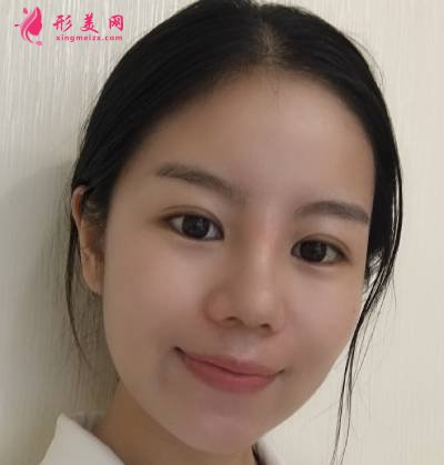 在重慶好美找畢勝做鼻綜合整形手術(shù)后