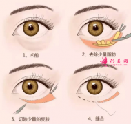手術(shù)切除眼袋會(huì)有后遺癥出現(xiàn)嗎？