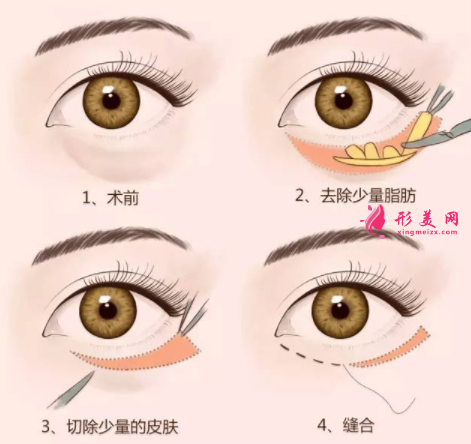 手術(shù)切除眼袋會(huì)有后遺癥出現(xiàn)嗎