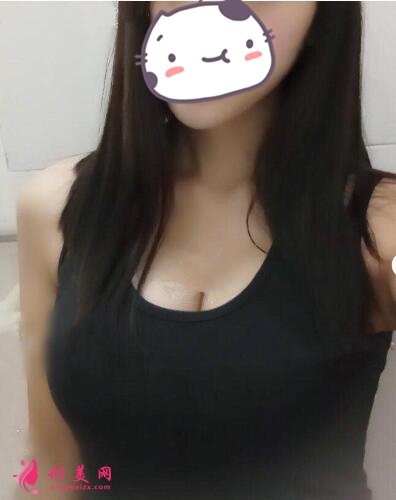 成都怡脂醫(yī)療美容醫(yī)院自體脂肪豐胸案例