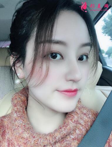 成都趙善軍博士整形美容門診部自體脂肪隆胸案例