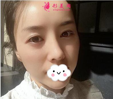 關(guān)于隆鼻的真實案例 相信很多朋友都在等我的分享