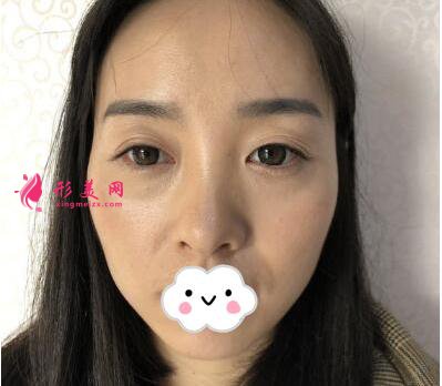 關(guān)于隆鼻的真實案例 相信很多朋友都在等我的分享