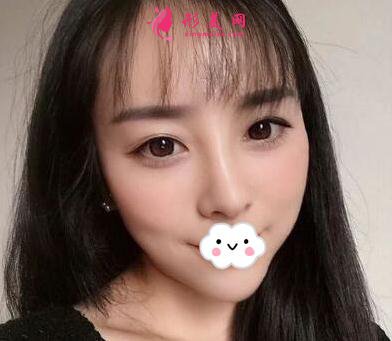 關(guān)于隆鼻的真實案例 相信很多朋友都在等我的分享