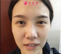 成都美立方整形醫(yī)院隆鼻案例 術(shù)后恢復(fù)效果反饋