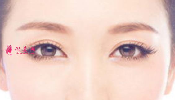 雙眼皮術(shù)后有點(diǎn)寬怎么修復(fù)
