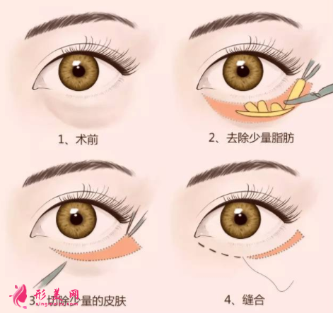 手術(shù)祛眼袋方法有哪些