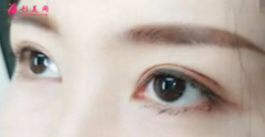 埋線雙眼皮使用的是什么線？