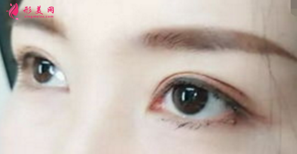 埋線雙眼皮使用的是什么線