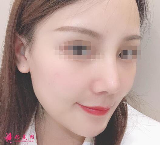 北京假體隆鼻修復(fù)手術(shù)日記，鼻子的重生記錄!