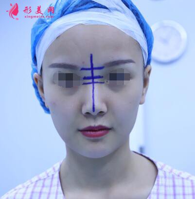 北京假體隆鼻修復(fù)手術(shù)日記，鼻子的重生記錄!