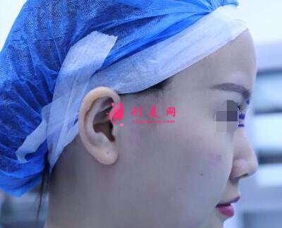 北京假體隆鼻修復(fù)手術(shù)日記，鼻子的重生記錄!