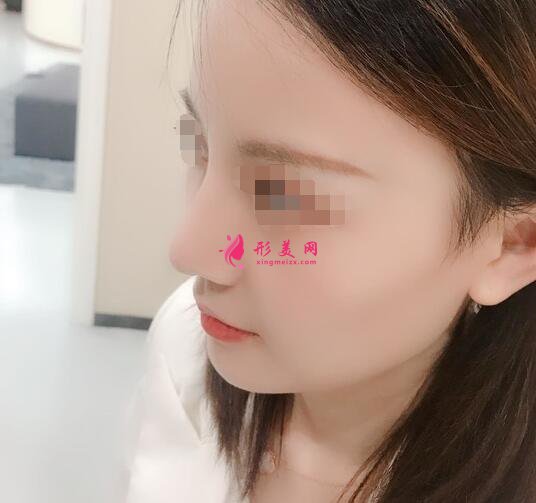 北京假體隆鼻修復(fù)手術(shù)日記，鼻子的重生記錄!