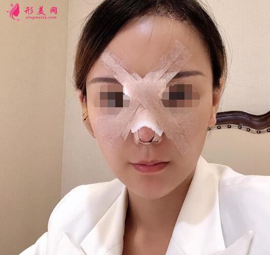 北京假體隆鼻修復(fù)手術(shù)日記，鼻子的重生記錄!