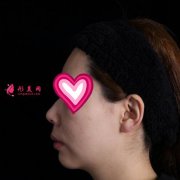 北大深圳醫(yī)院隆鼻案例圖錦集，塌鼻子兩個(gè)月逆襲初戀臉！