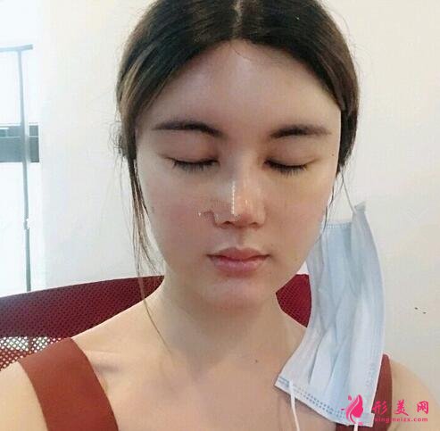 北大深圳醫(yī)院隆鼻案例圖錦集，塌鼻子兩個月逆襲初戀臉！