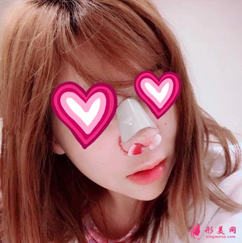 北大深圳醫(yī)院隆鼻案例圖錦集，塌鼻子兩個月逆襲初戀臉！