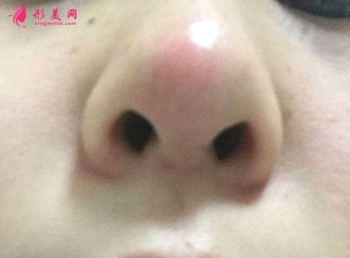 假體隆鼻后鼻尖發(fā)紅怎么回事