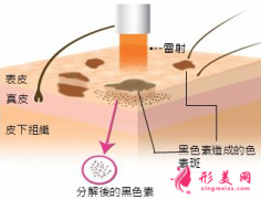 激光治療黃褐斑每次要間隔多久