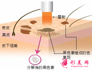 激光治療黃褐斑每次要間隔多久