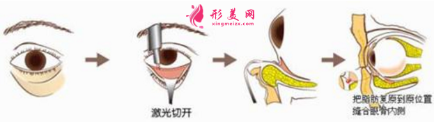 激光去眼袋要多少錢