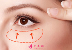 手術(shù)切除眼袋后多久恢復(fù)自然？