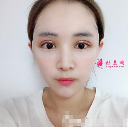術后七天照片