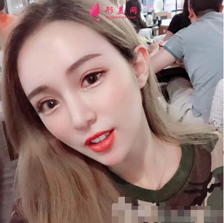 術后兩個月效果圖