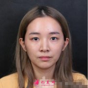 深圳美萊周洪超醫(yī)生雙眼皮案例術(shù)后效果反饋