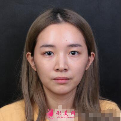 深圳美萊周洪超醫(yī)生雙眼皮