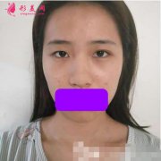 深圳陽光醫(yī)院陳星光隆鼻案例，塌鼻世紀難題終于解決！