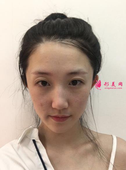 深圳香蜜麗格醫(yī)療美容激光祛斑案例，膚如凝脂~