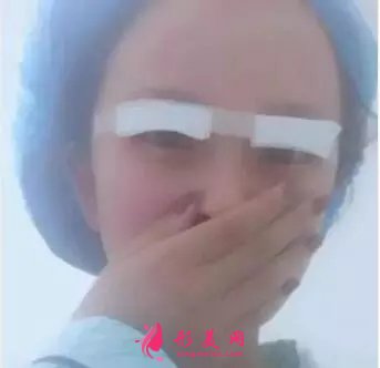 北大深圳李天石雙眼皮案例，無神小眼睛的蛻變記錄！