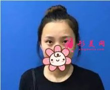 北大深圳李天石雙眼皮案例，無(wú)神小眼睛的蛻變記錄！