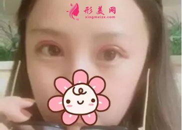 北大深圳李天石雙眼皮案例，無神小眼睛的蛻變記錄！
